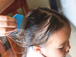 How to treat LICE