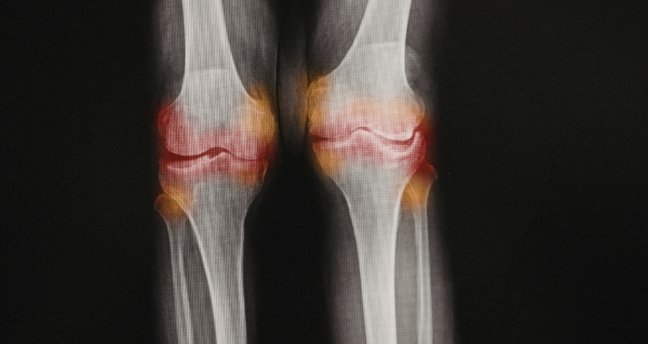 BONE HEALTH: PART 4